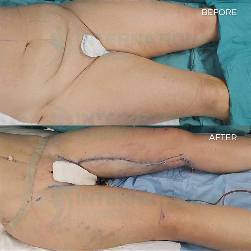 Images Mini Thigh Lift Before and After 